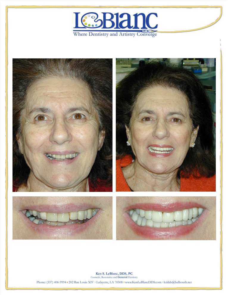 Lafayette Dental Implant Restoration